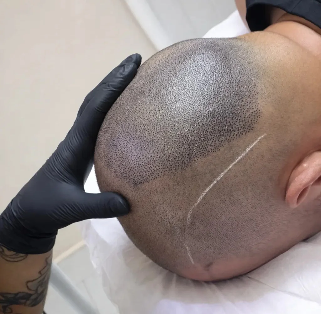 micropigmentación capilar gijón