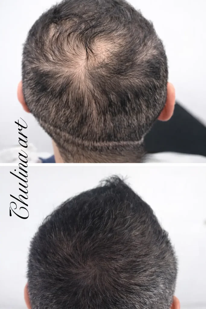 micropigmentacion medica