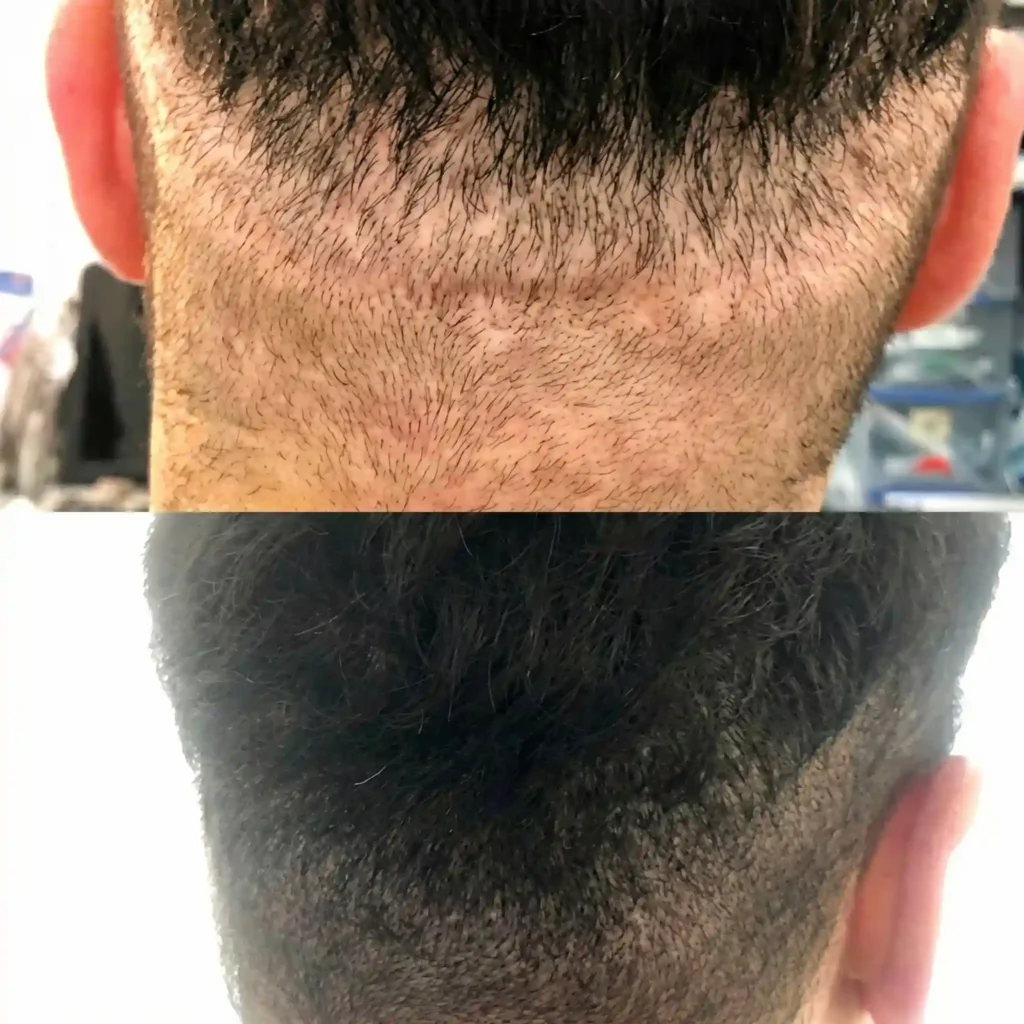 resultado micro capilar